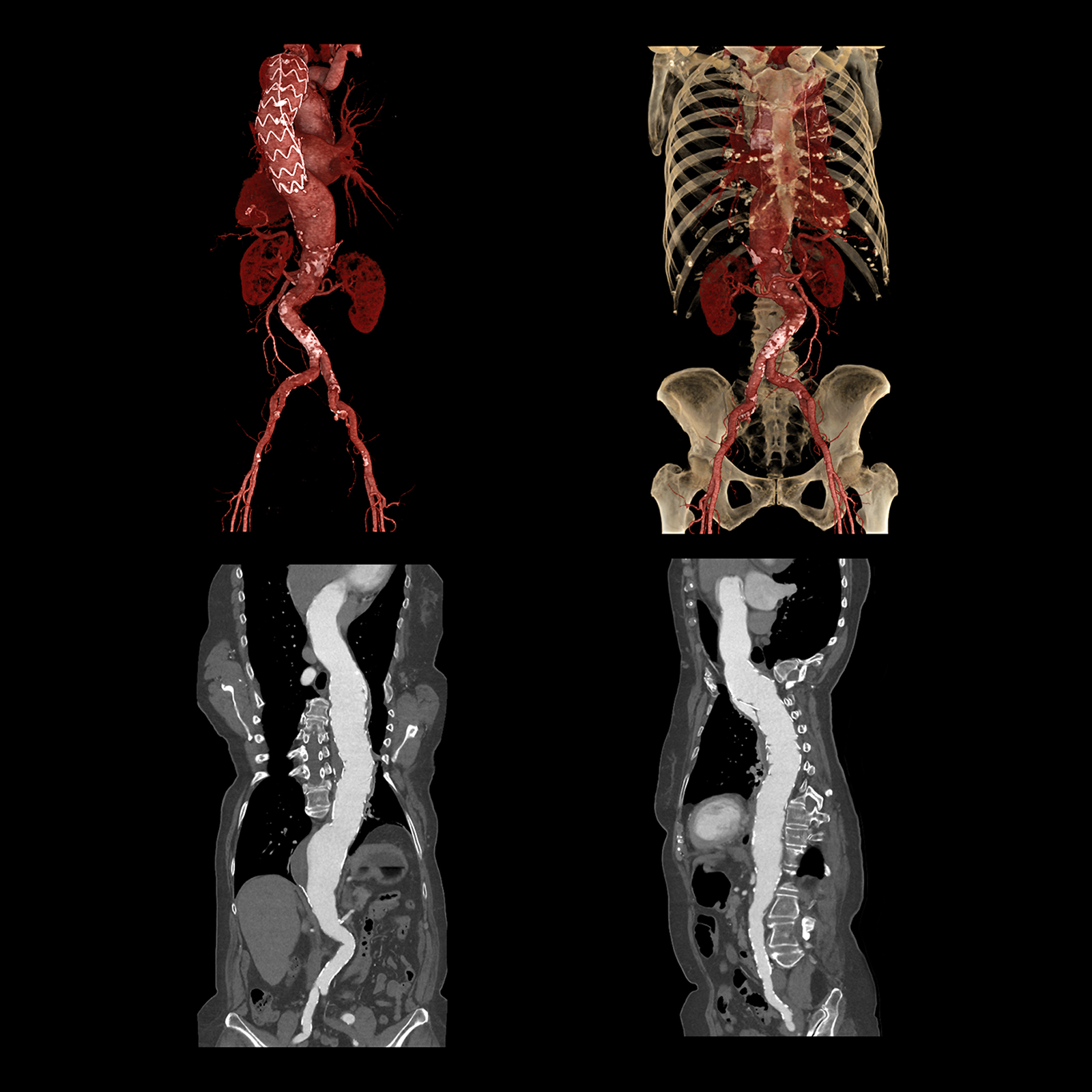 Aquilion ONE / PRISM Edition Thoracic Aorta Stent Follow up, AiCE