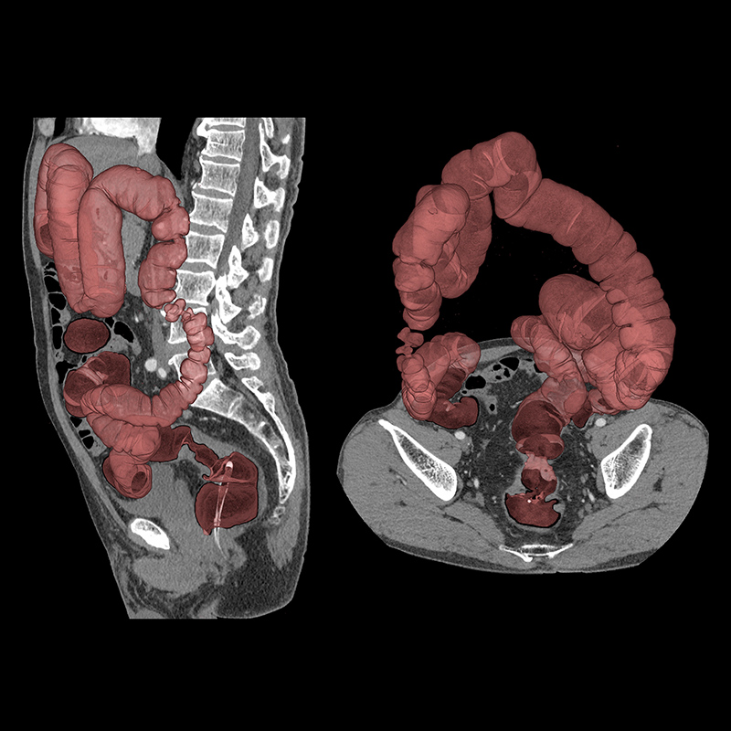 Aquilion Precision Colo-Rectal Cancer, HR, AiCE