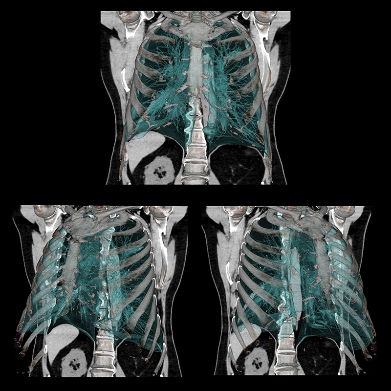Aquilion Prime SP Chest Lesions, AiCE
