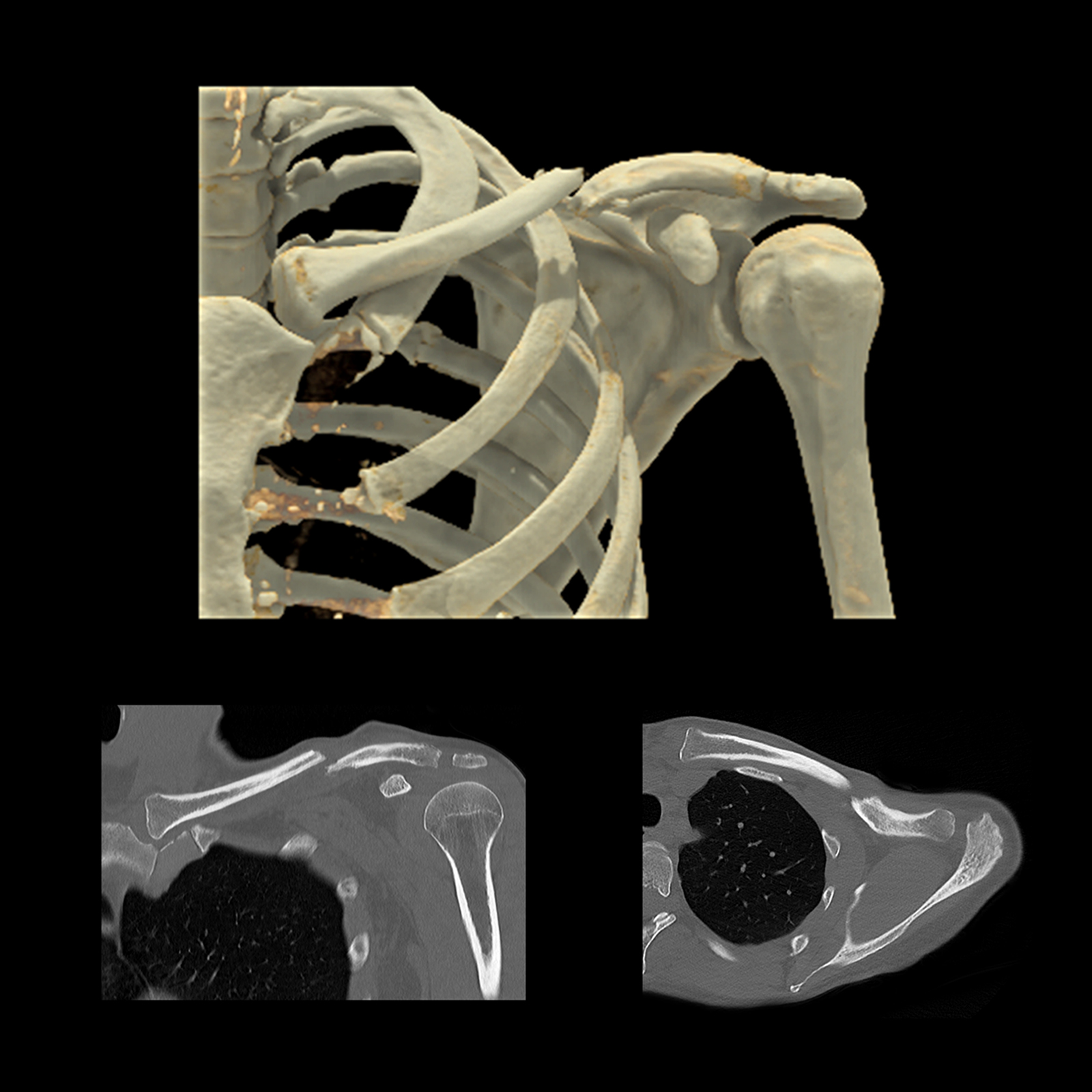 Aquilion ONE / GENESIS Edition Clavicle Non-united Fracture, AiCE