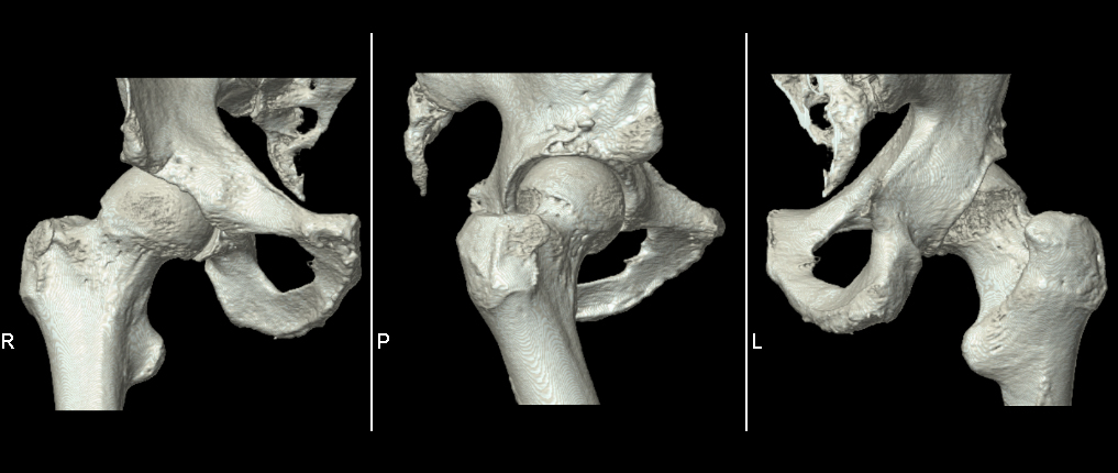 Aquilion Exceed LB Hips