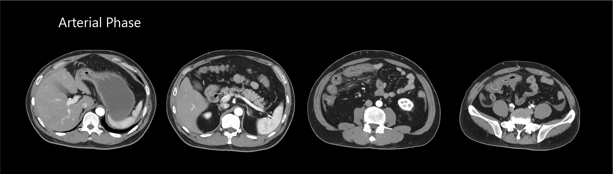 Aquilion Exceed LB AiCE Abdomen and Pelvis
