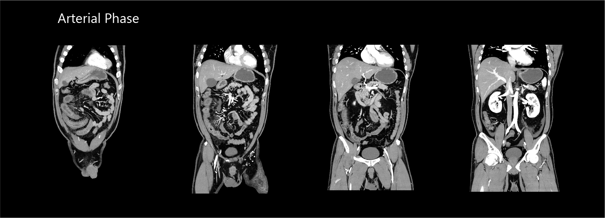 Aquilion Exceed LB AiCE Abdomen and Pelvis