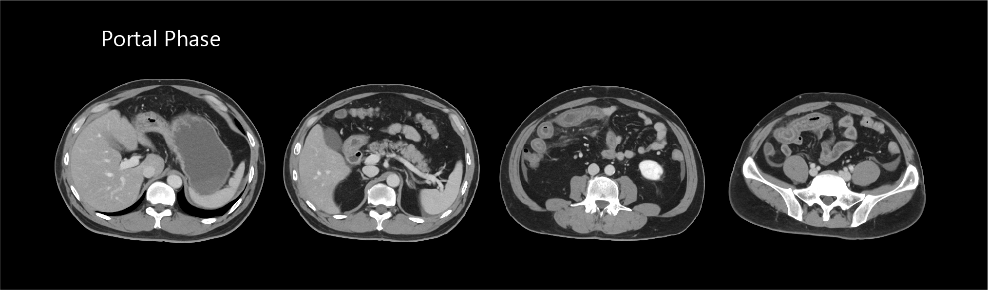 Aquilion Exceed LB AiCE Abdomen and Pelvis