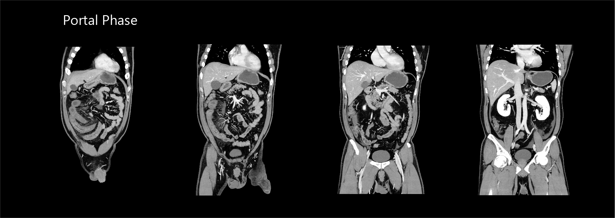 Aquilion Exceed LB AiCE Abdomen and Pelvis
