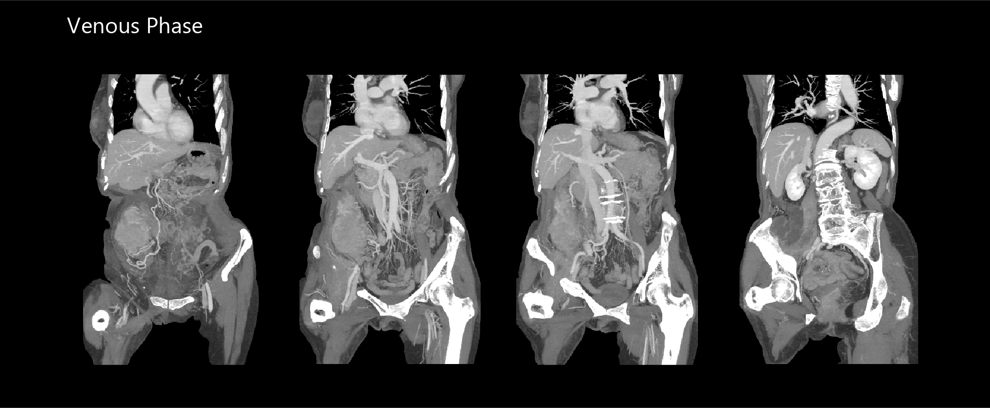 Aquilion Exceed LB AiCE Abdomen & Pelvis