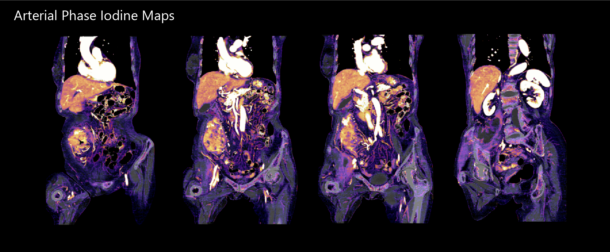 Aquilion Exceed LB AiCE Abdomen & Pelvis