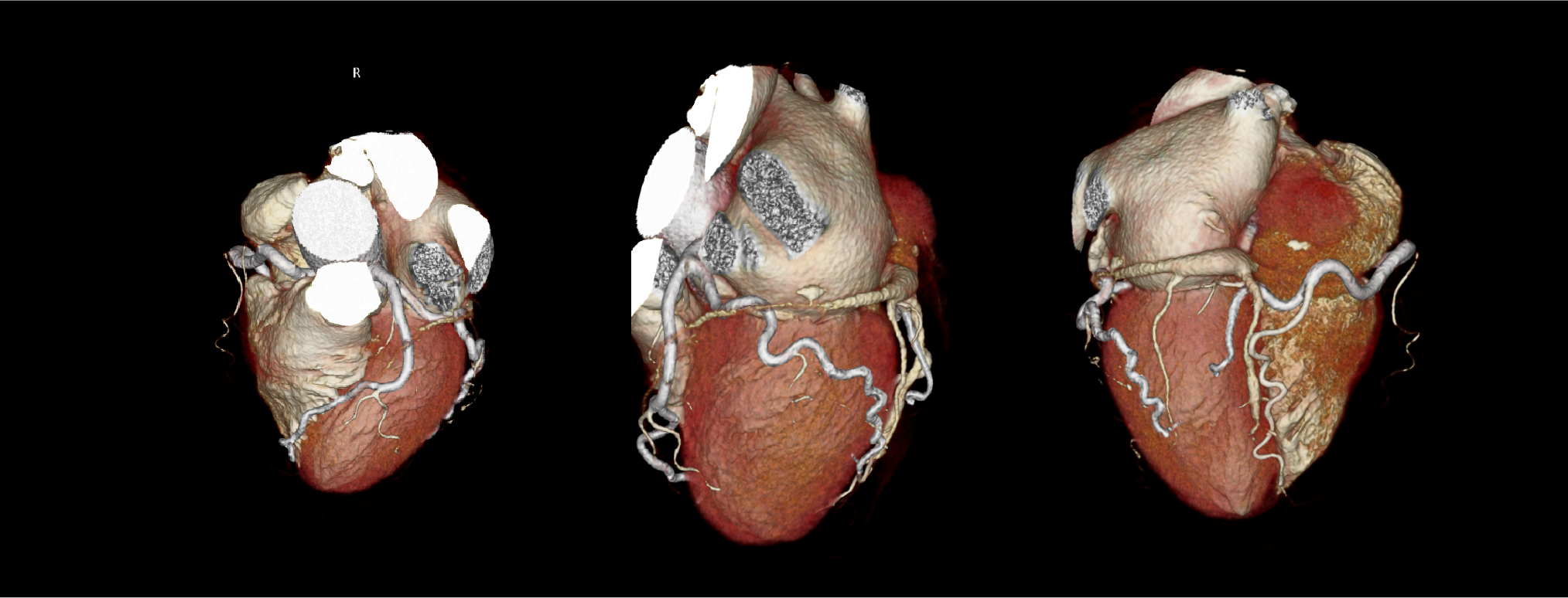 Aquilion Exceed LB AiCE Cardiac