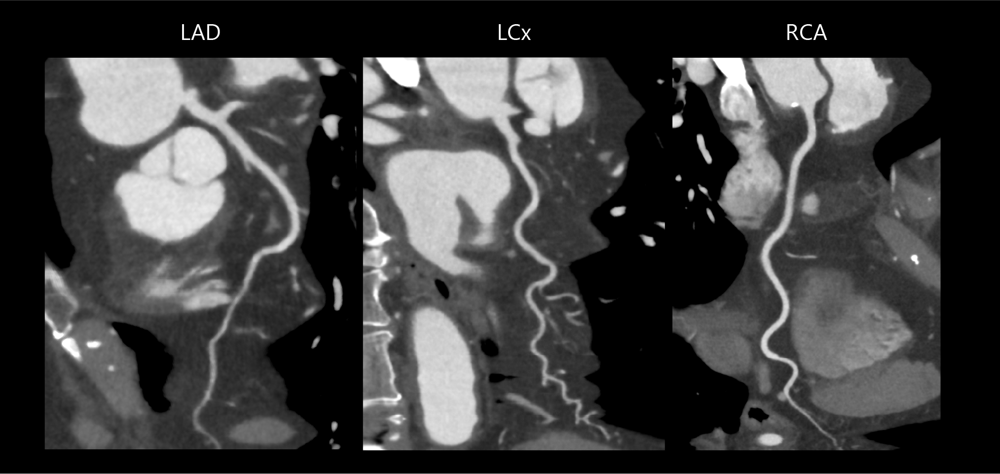 Aquilion Exceed LB AiCE Cardiac