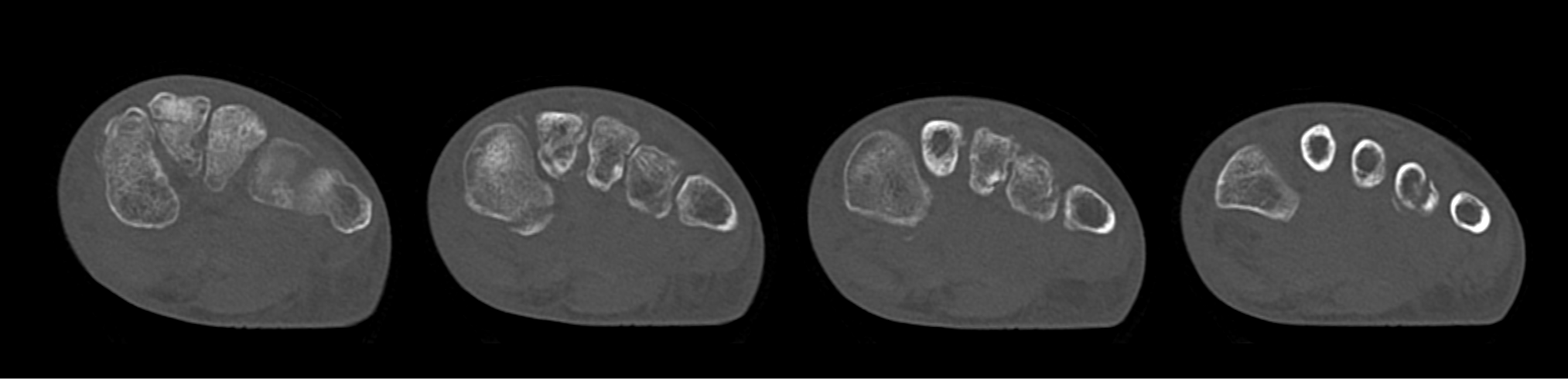 Aquilion Exceed LB Foot Fracture