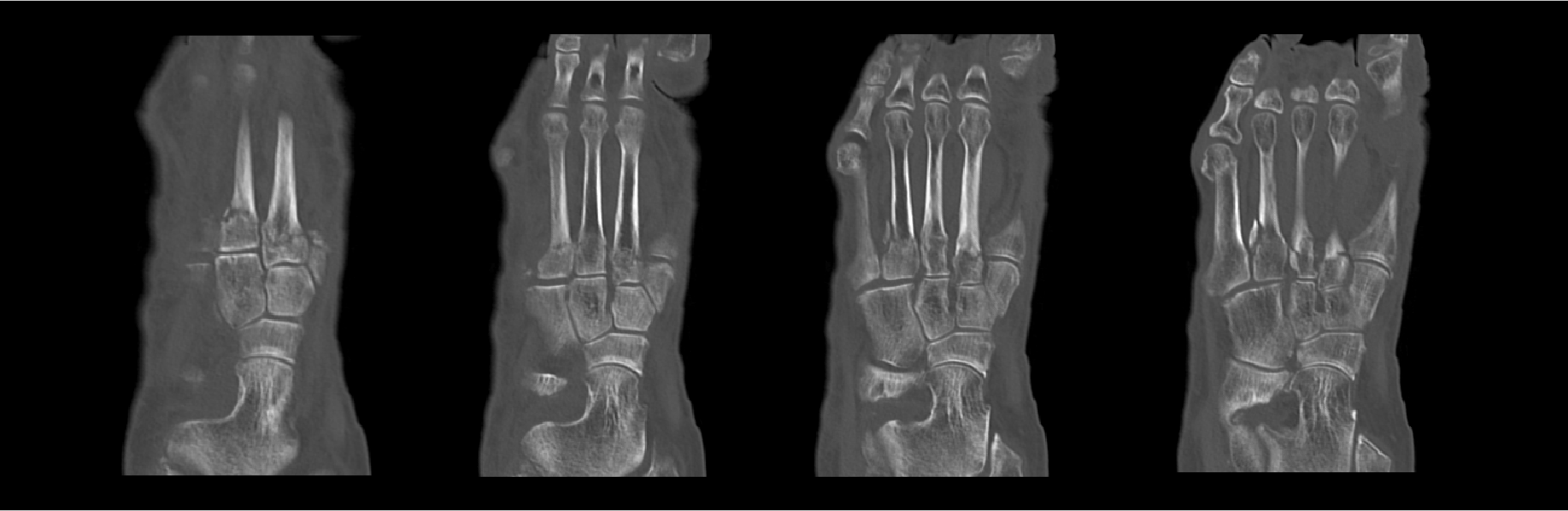 Aquilion Exceed LB Foot Fracture