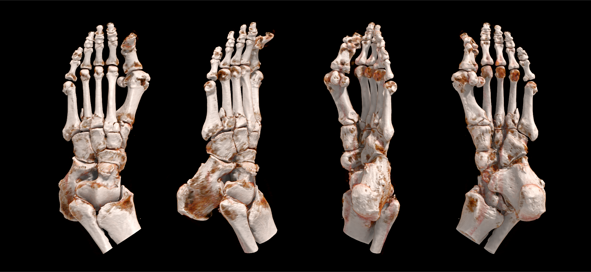 Aquilion Exceed LB Foot Fracture