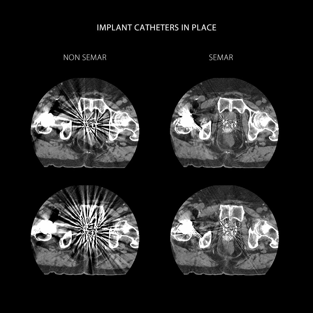 Aquilion Exceed LB Prostate Cancer CT Simulation HDR Brachytherapy, AiCE, SEMAR