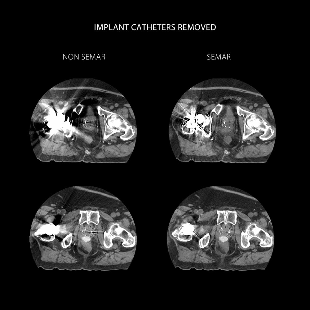 Aquilion Exceed LB Prostate Cancer CT Simulation HDR Brachytherapy, AiCE, SEMAR