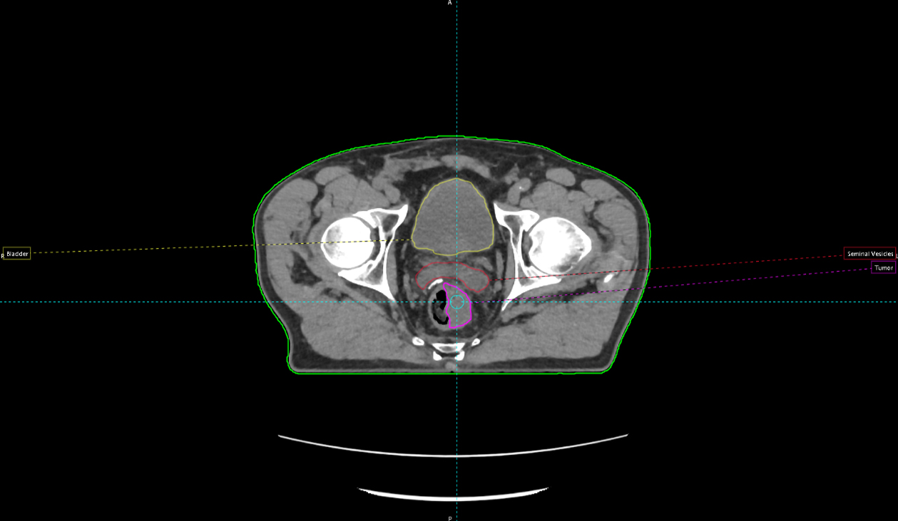 Aquilion Exceed LB Abdomen and Pelvis