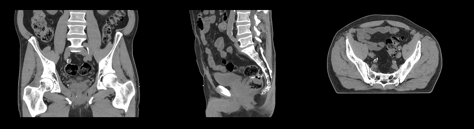 Aquilion Exceed LB Abdomen and Pelvis