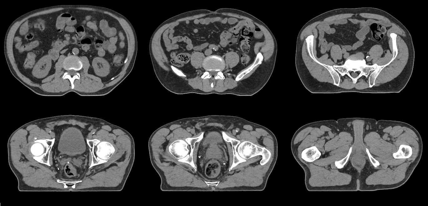Aquilion Exceed LB Abdomen and Pelvis
