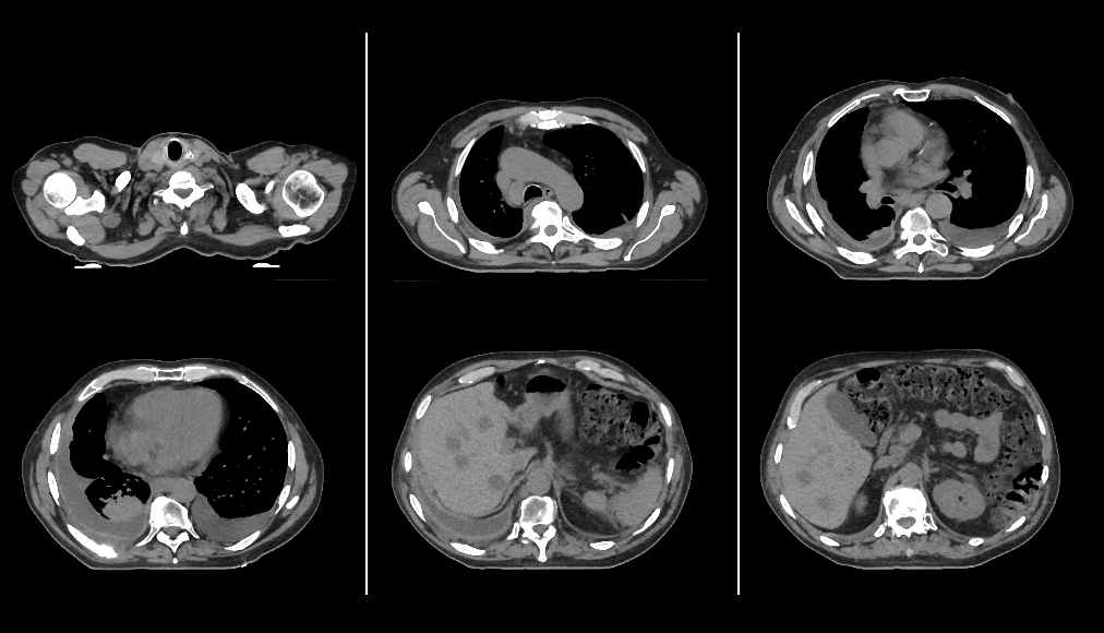 Aquilion Exceed LB Chest and Upper Abdomen
