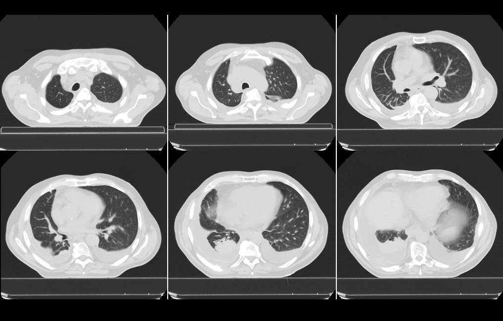 Aquilion Exceed LB Chest and Upper Abdomen