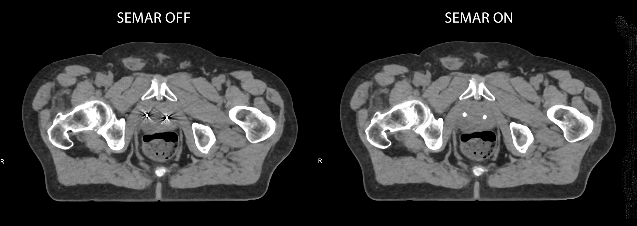 Aquilion Exceed LB Prostate with Gold Fiducial markers