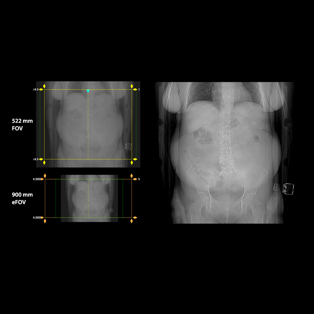 Aquilion Exceed LB Abdominal Carcinoma, AiCE