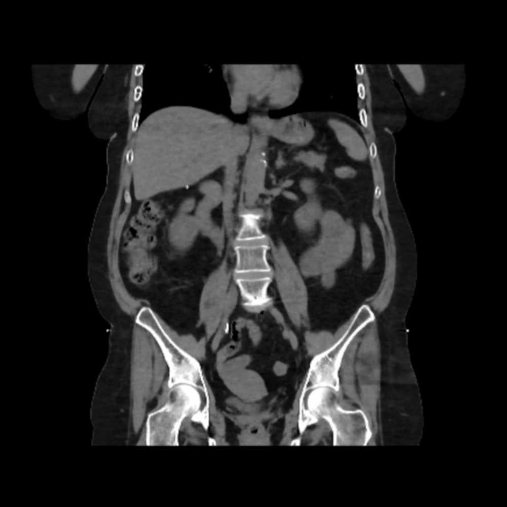 Aquilion Exceed LB Abdominal Carcinoma, AiCE