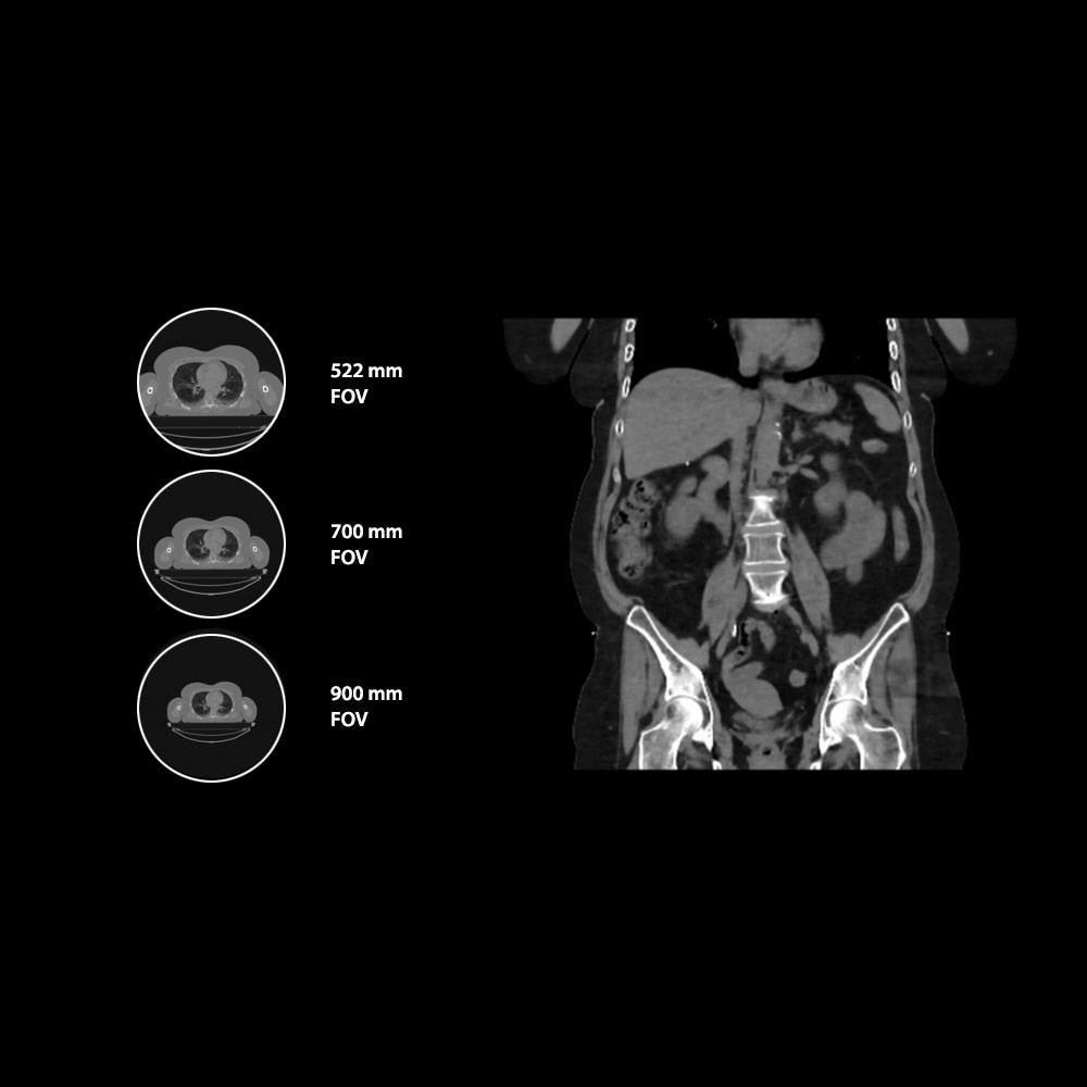 Aquilion Exceed LB Abdominal Carcinoma, AiCE