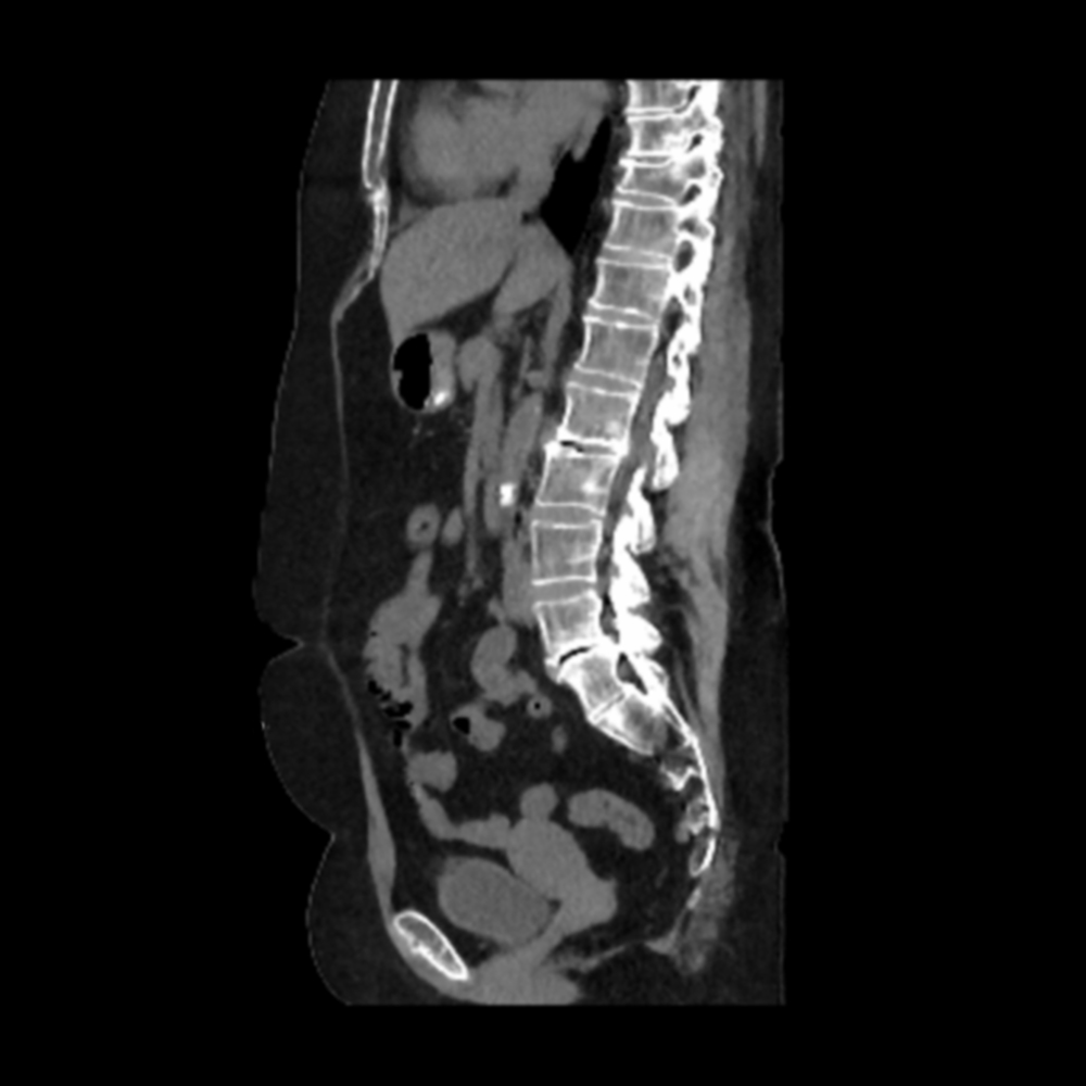 Aquilion Exceed LB Abdominal Carcinoma, AiCE