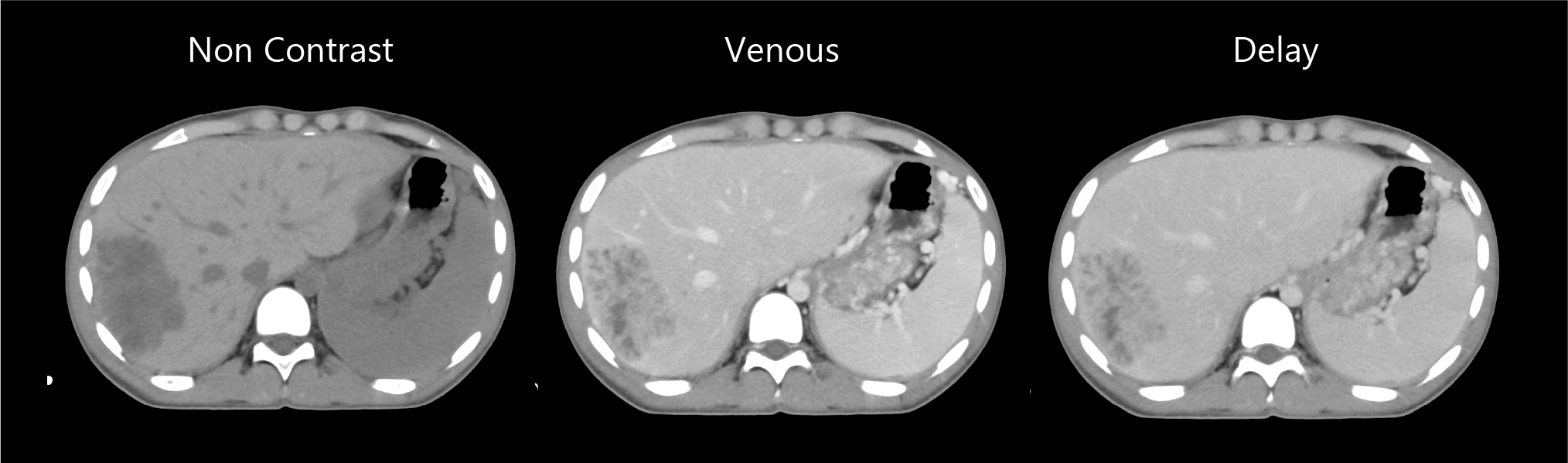 Aquilion Exceed LB Liver SBRT