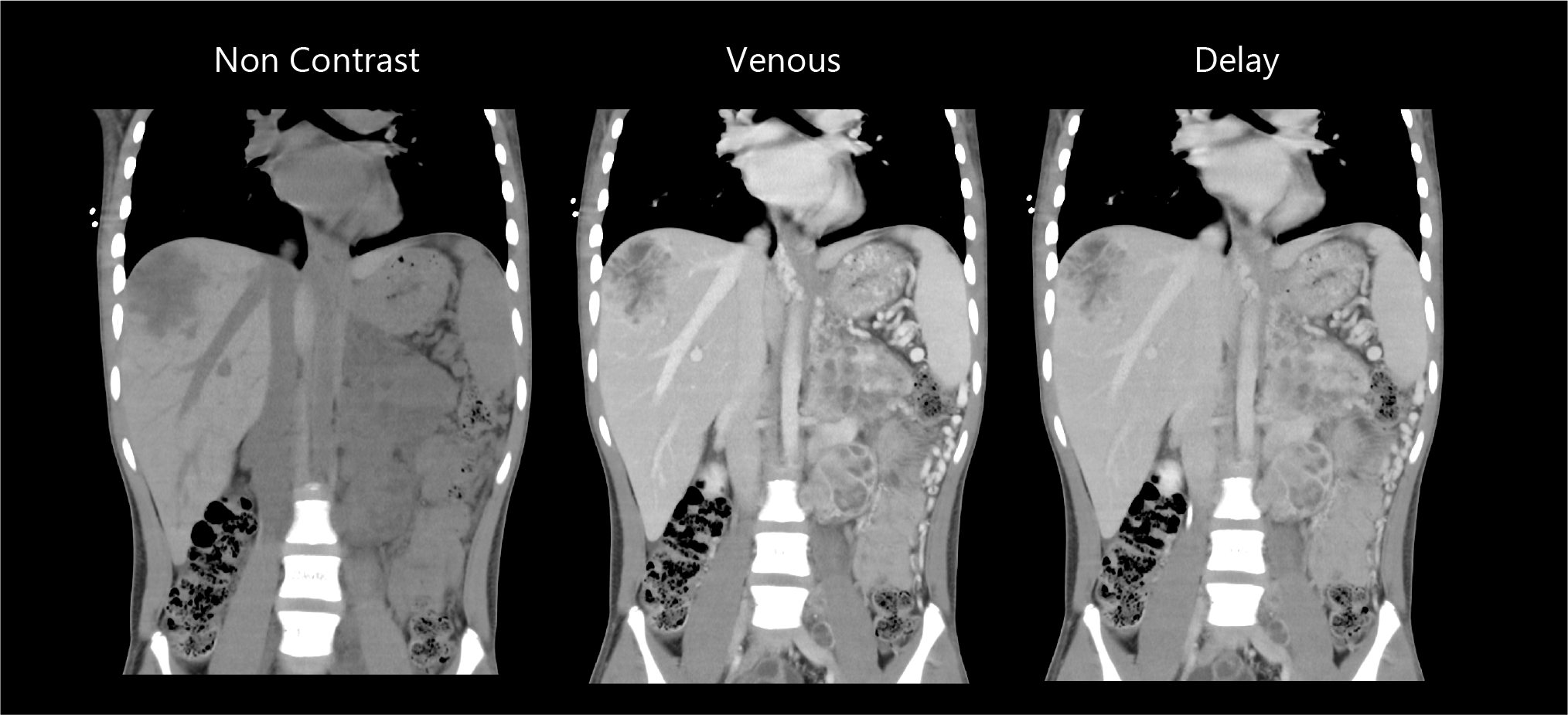 Aquilion Exceed LB Liver SBRT