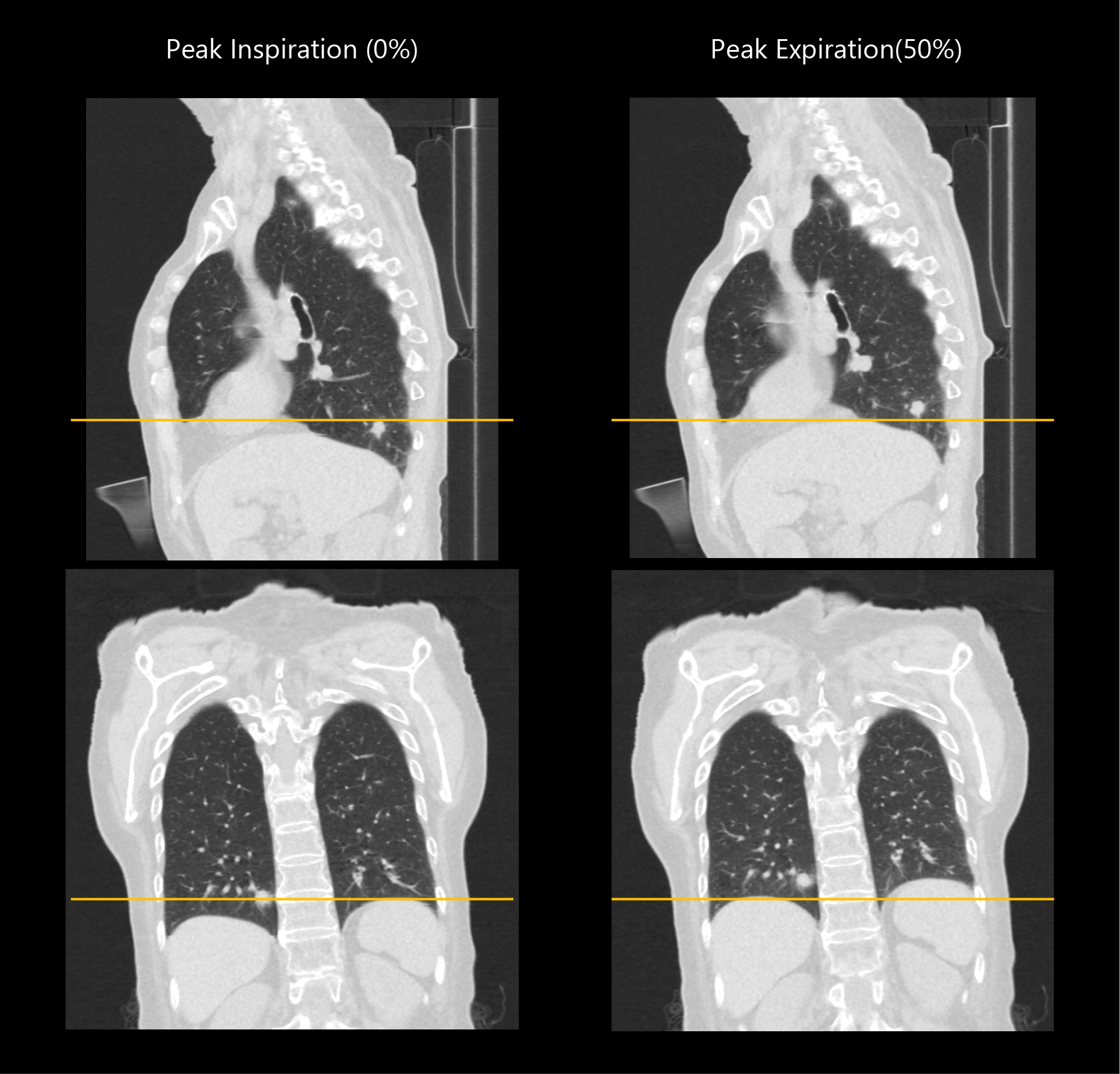 Aquilion Exceed LB Respiratory Gated Chest