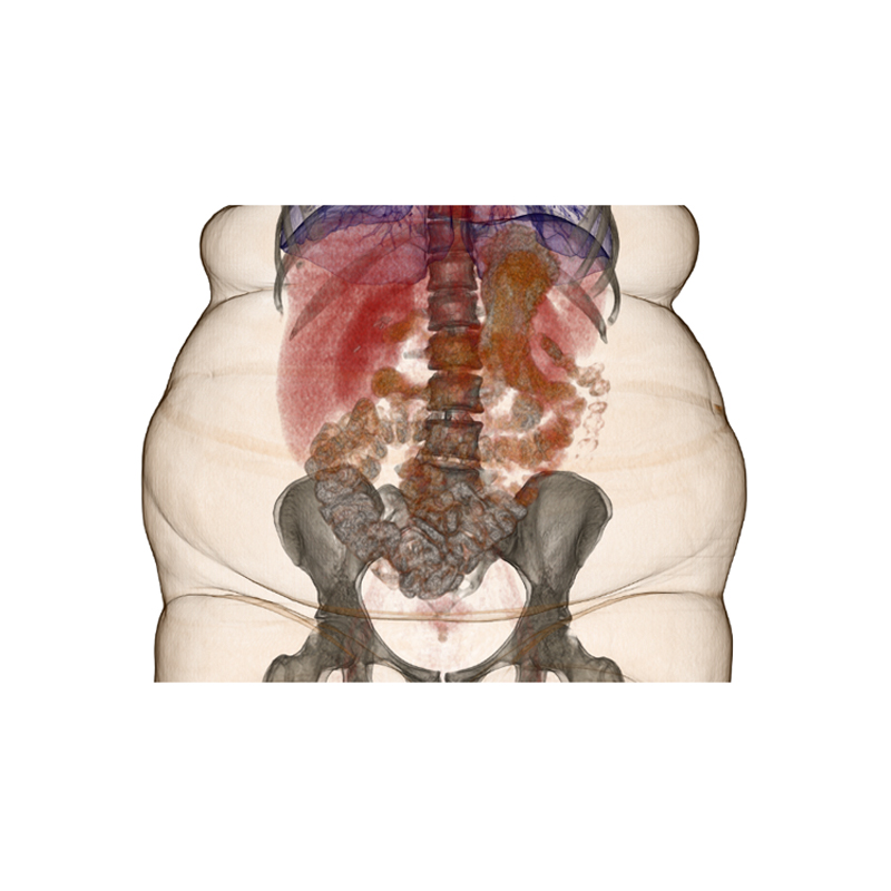 Aquilion LB Abdominal CT