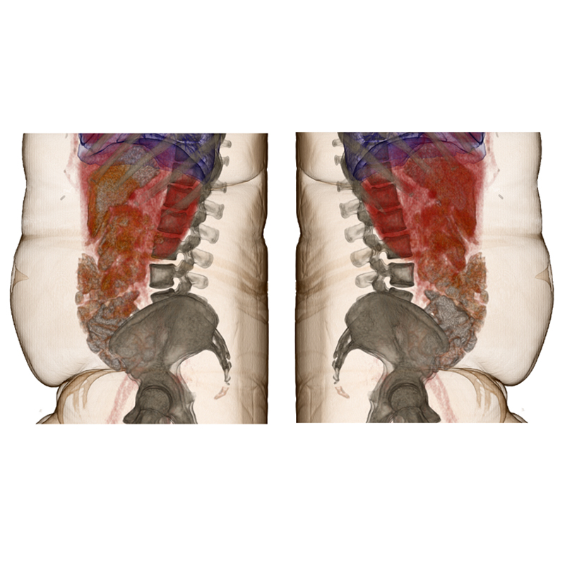 Aquilion LB Abdominal CT