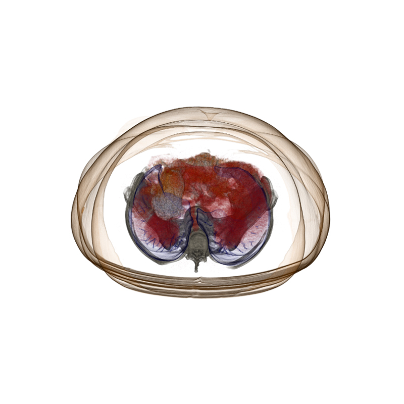 Aquilion LB Abdominal CT