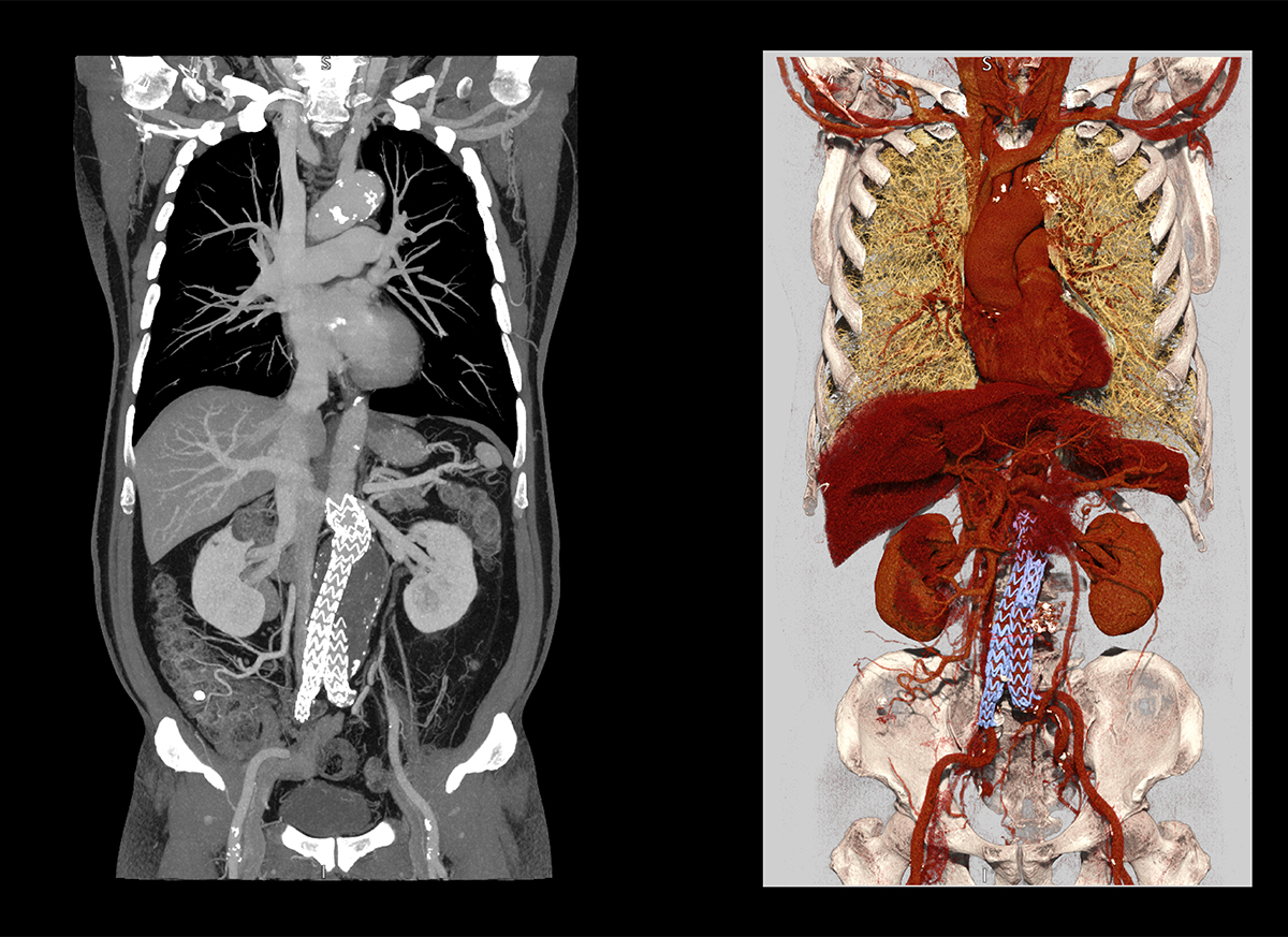 Photon Counting CT Abdominal Aortic Aneurysm