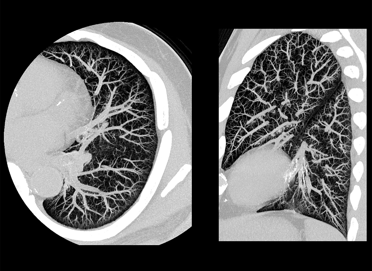 Photon Counting CT Chest1
