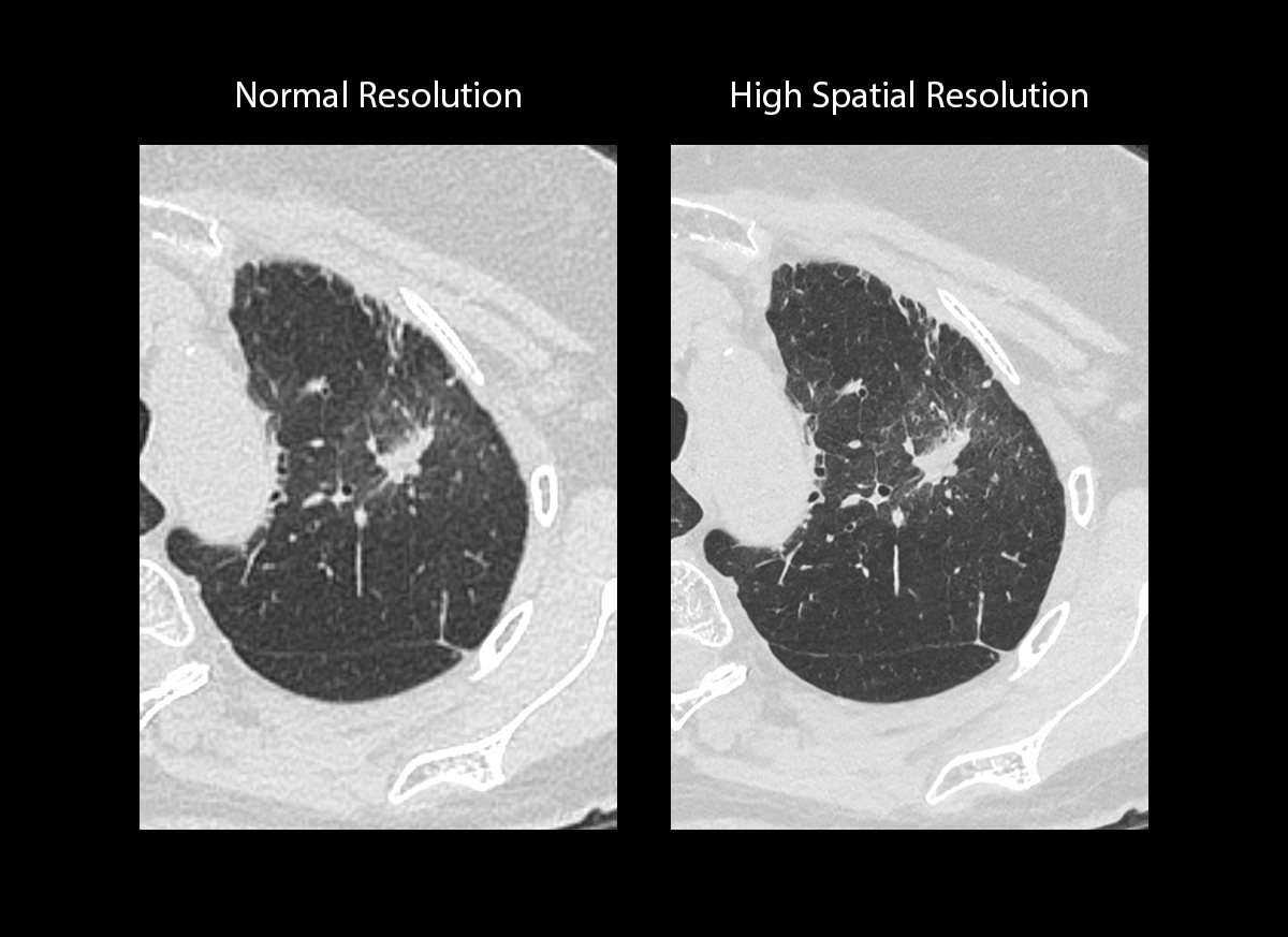 Photon Counting CT Chest4
