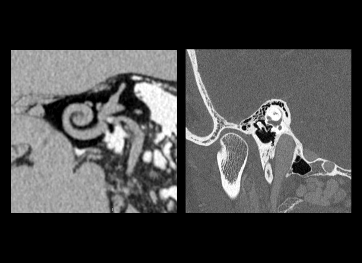 Photon Counting CT Inner Ear