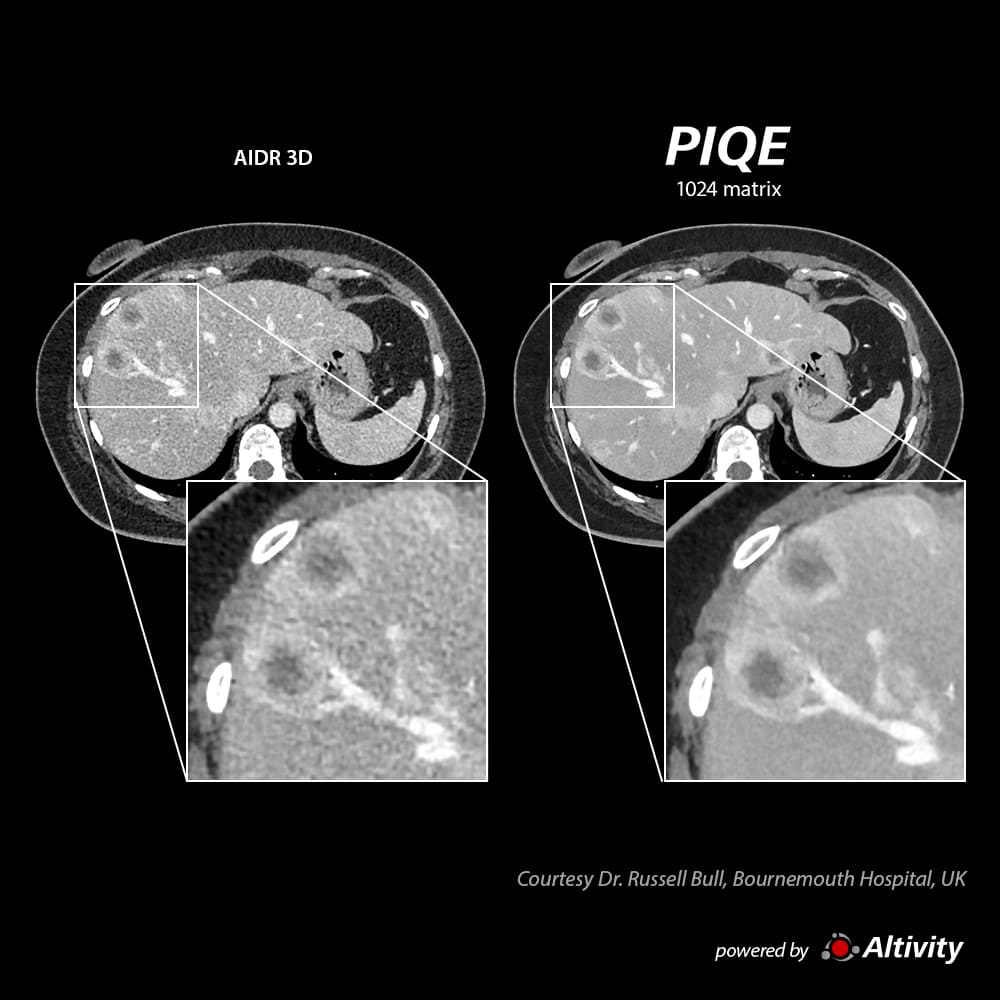 Precise IQ Engine Venous Phase Abdomen
