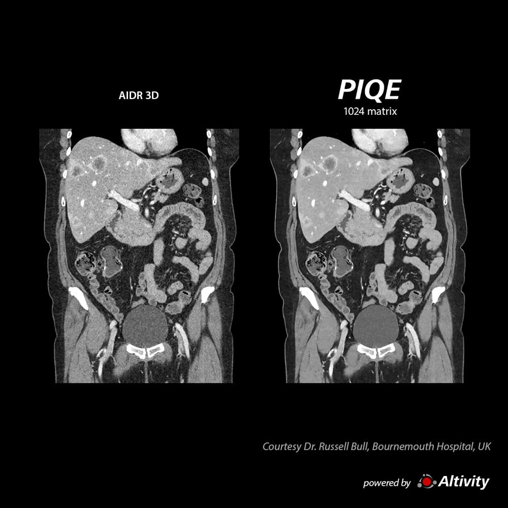 Precise IQ Engine Venous Phase Abdomen