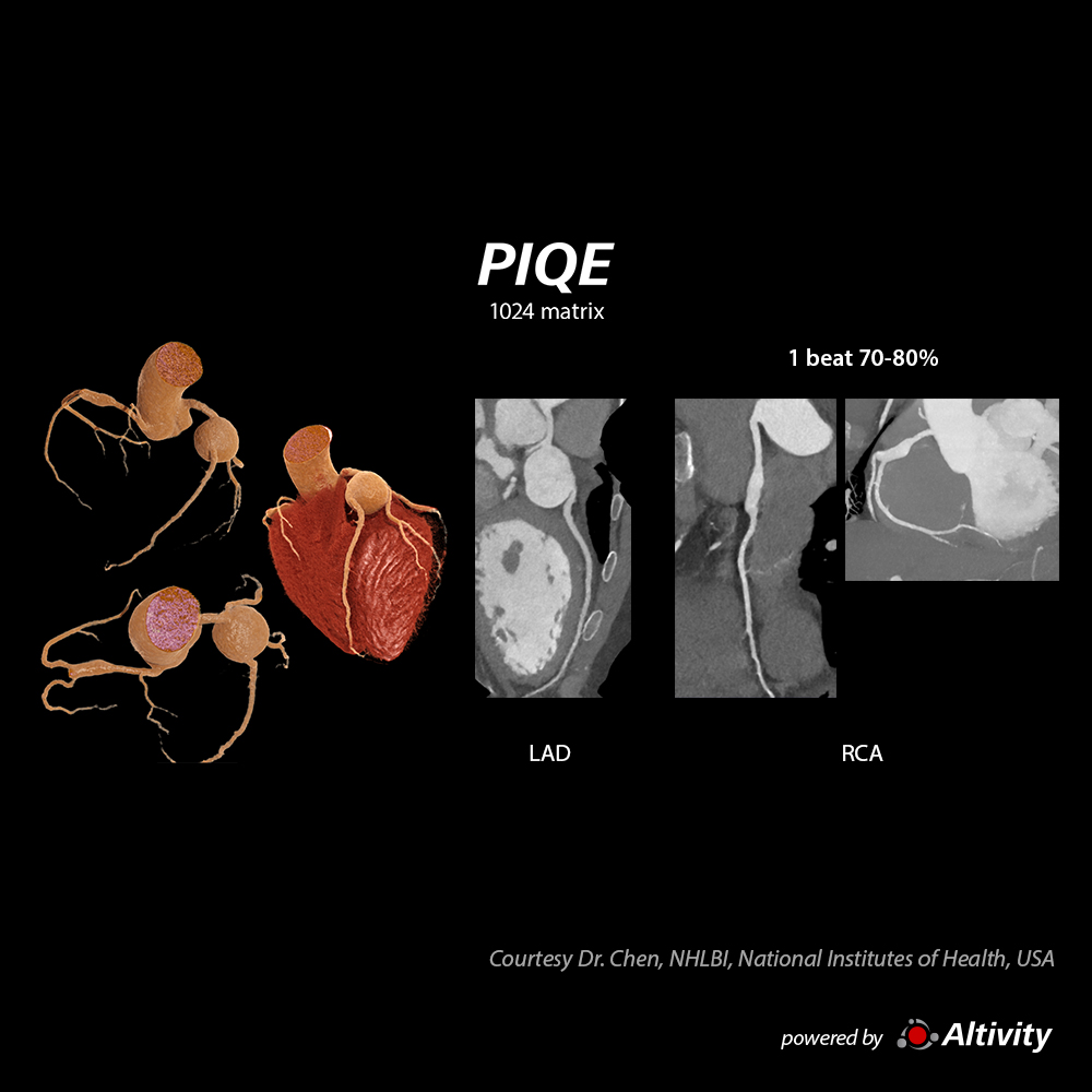 Precise IQ Engine Venous Phase Aneurysms HR 60bpm