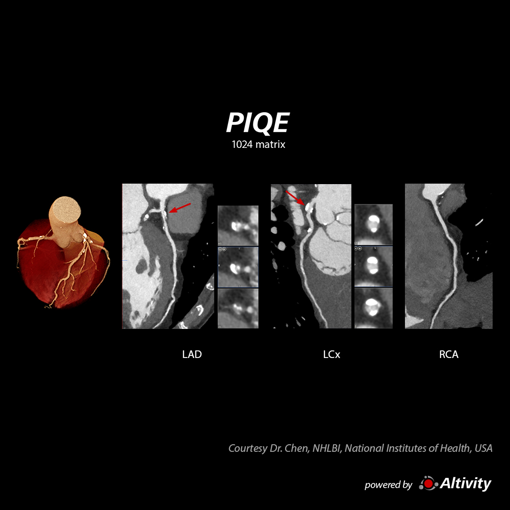 Precise IQ Engine Venous Phase Plaque HR 62bpm