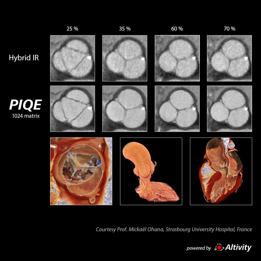 Precise IQ Engine Venous Phase 4D Aortic Valve