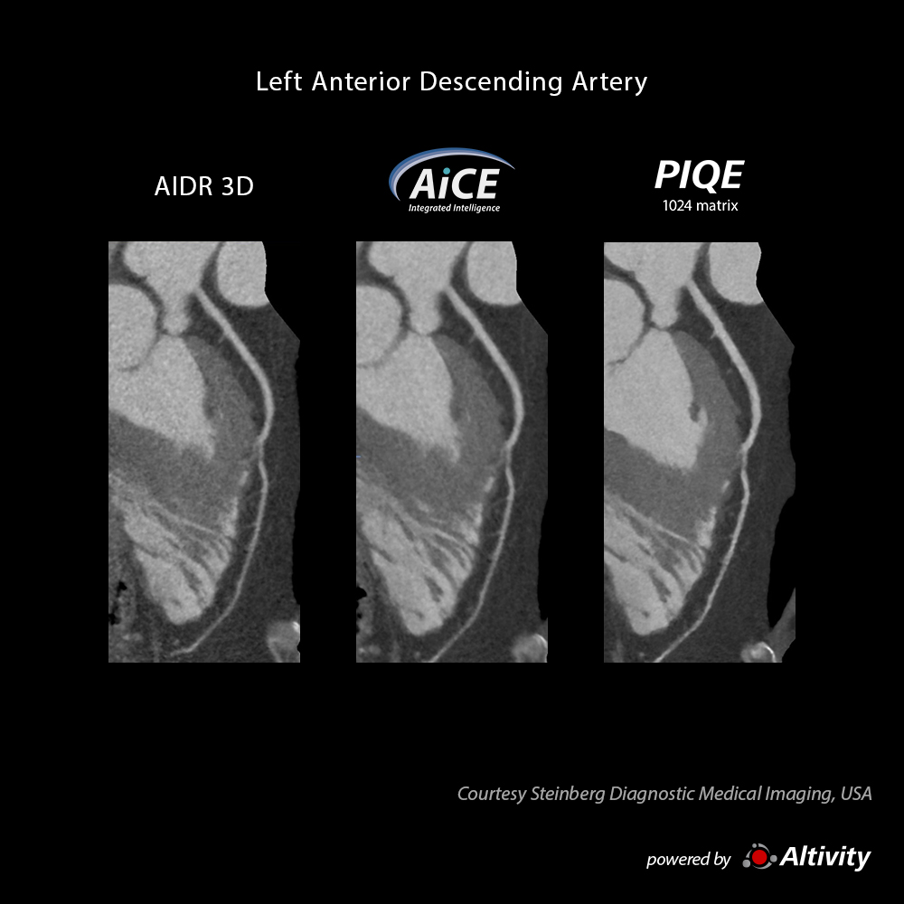 Precise IQ Engine Venous Phase Cardiac