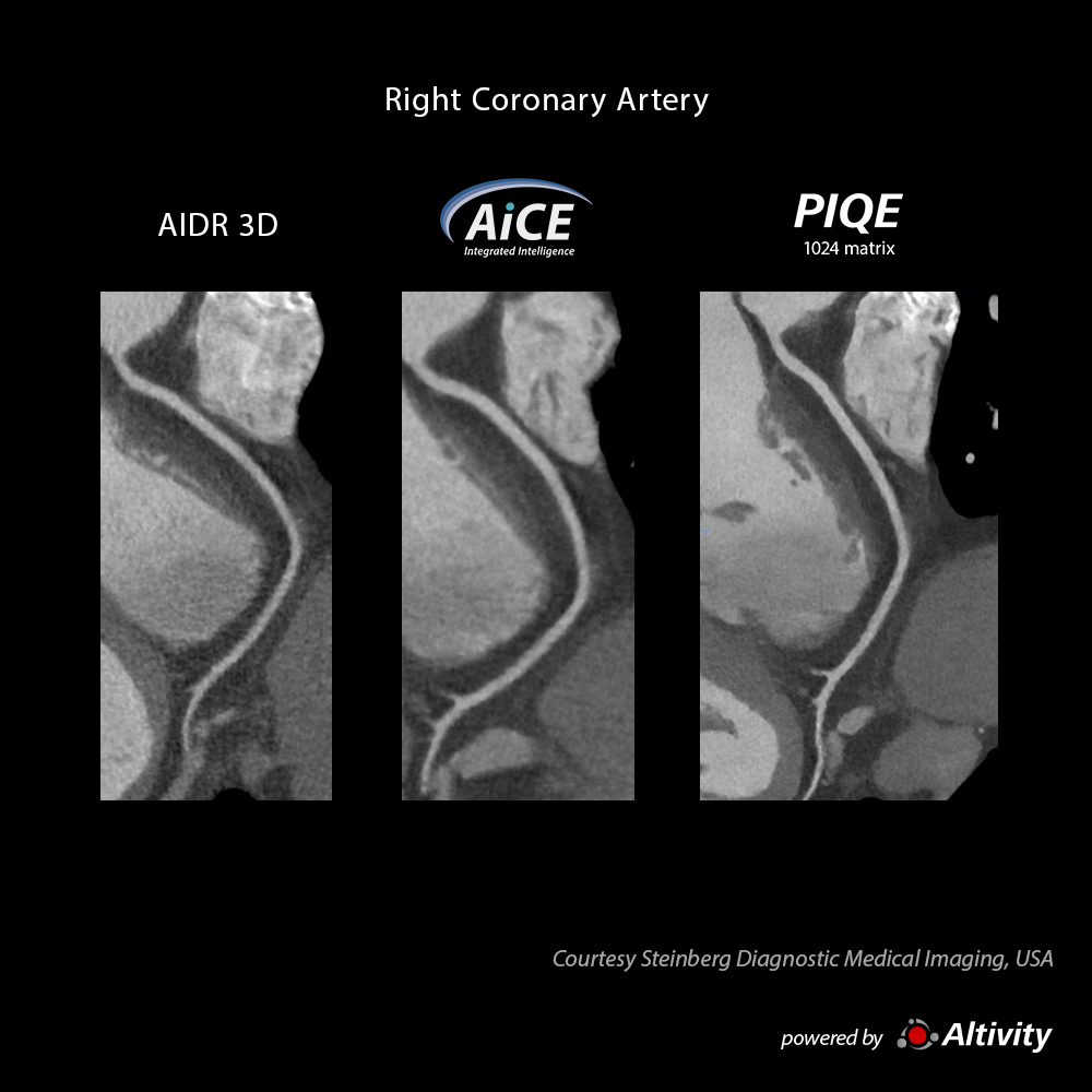 Precise IQ Engine Venous Phase Cardiac