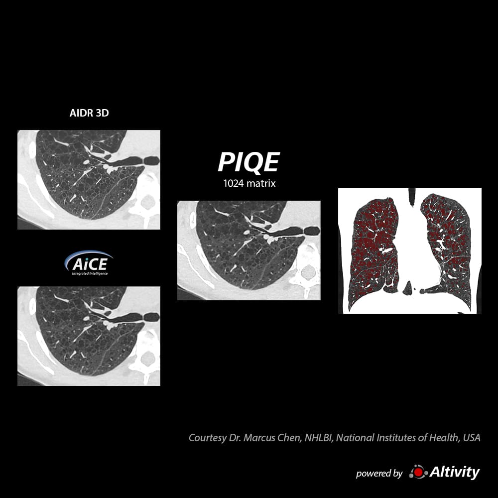 Precise IQ Engine Venous Phase